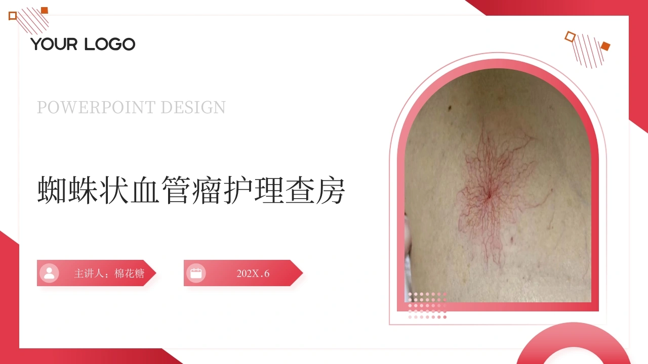 C633蜘蛛状血管瘤护理查房带参考文献PPT