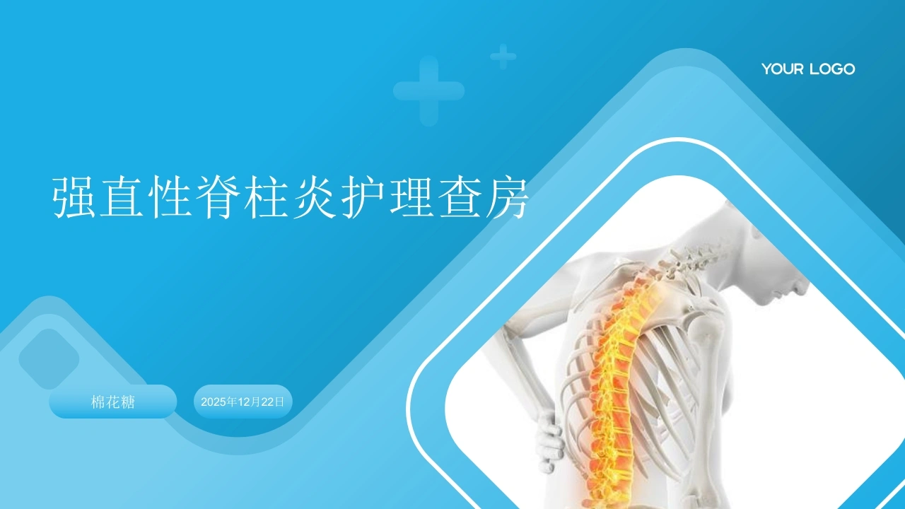 C817强直性脊柱炎护理查房带参考文献PPT