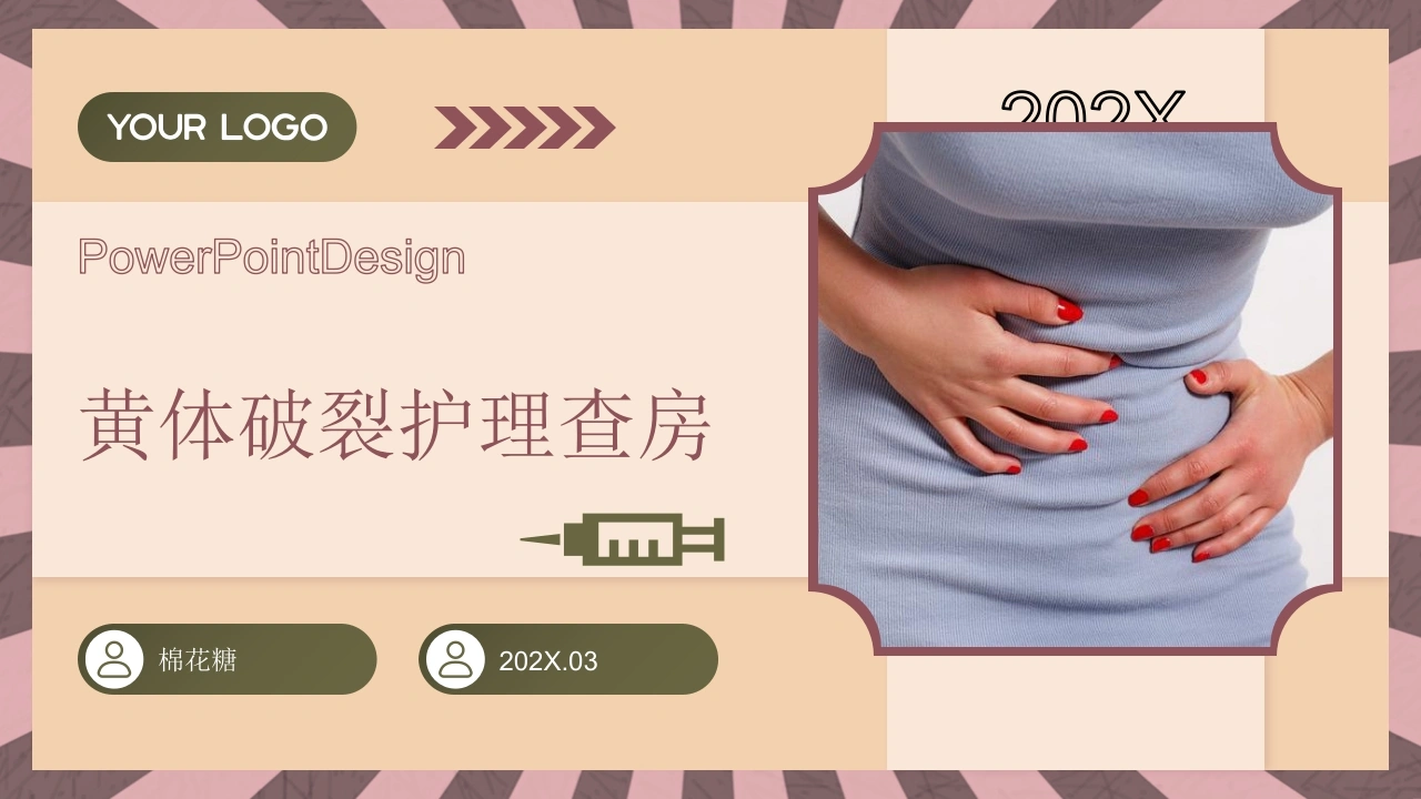 C897黄体破裂护理查房带参考文献PPT