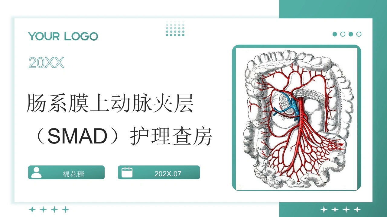 C957肠系膜上动脉夹层（SMAD）护理查房带参考文献PPT