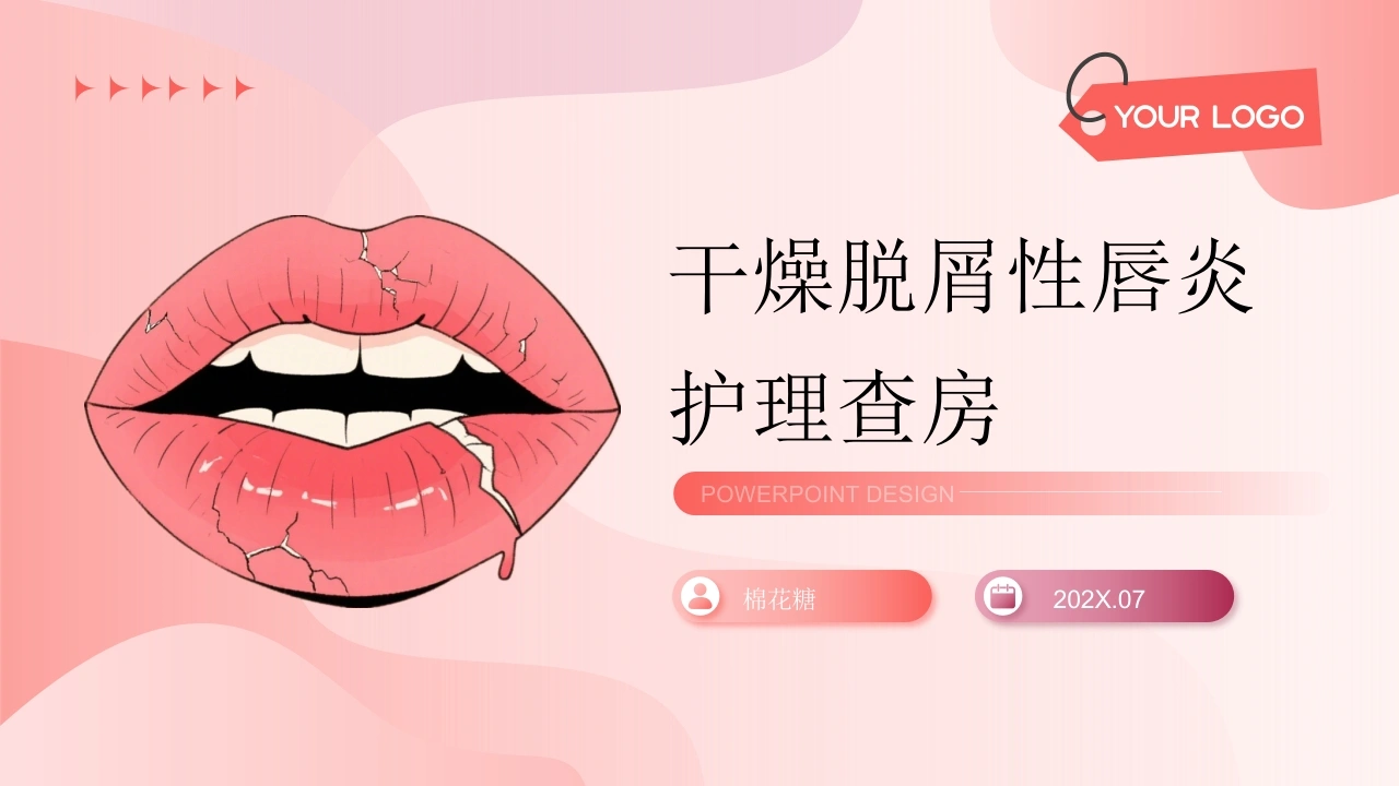C967干燥脱屑性唇炎护理查房带参考文献-白衣资料网