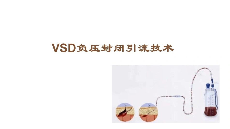 VSD负压封闭引流技术-13页-白衣资料网