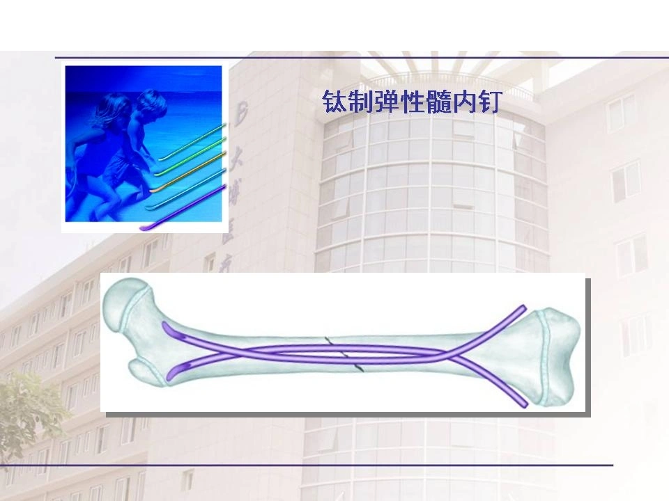 W209弹性髓内钉治疗儿童骨折操作技巧PPT课件-白衣资料网