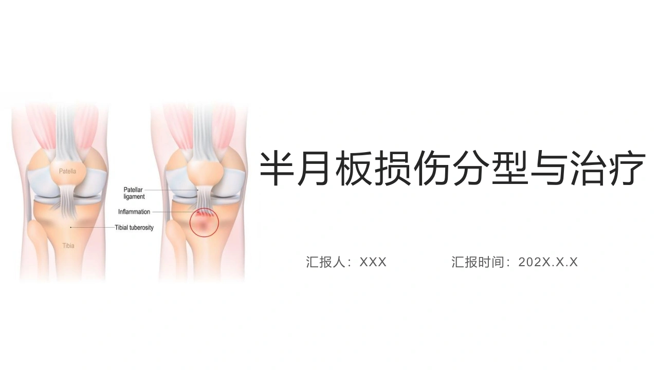 半月板损伤分型与治疗D305-白衣资料网