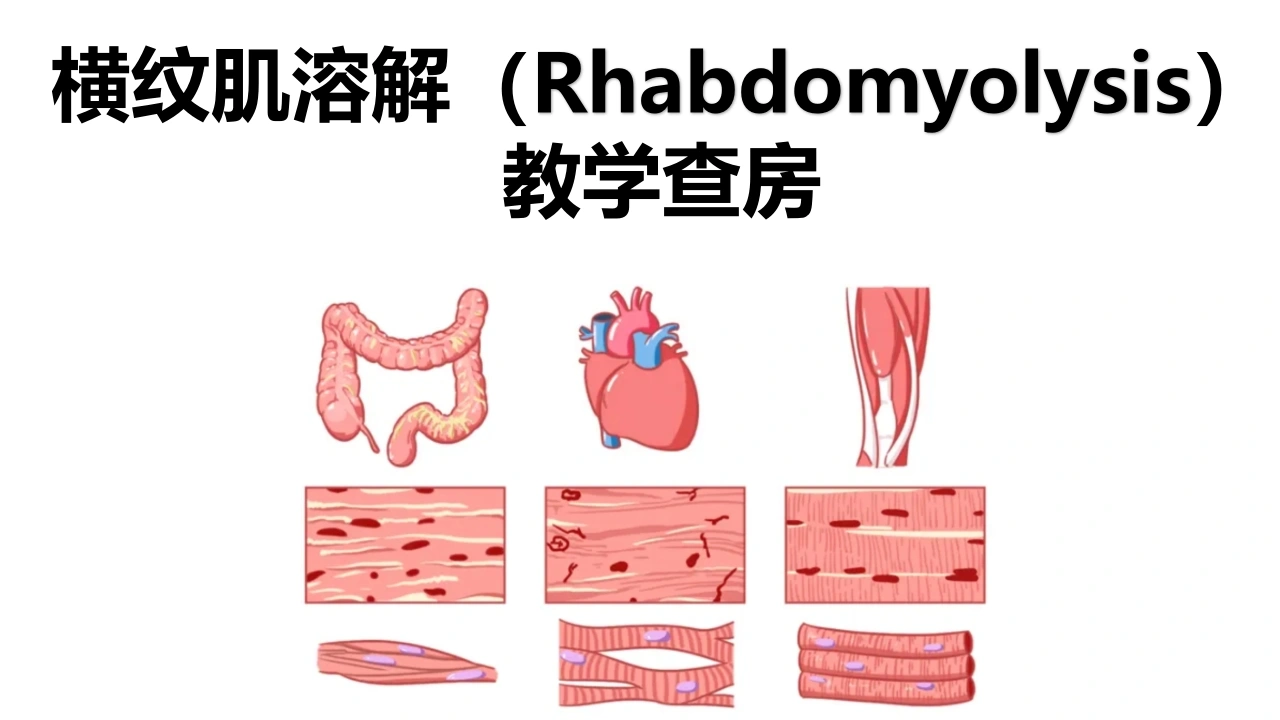 横纹肌溶解教学查房C262-白衣资料网