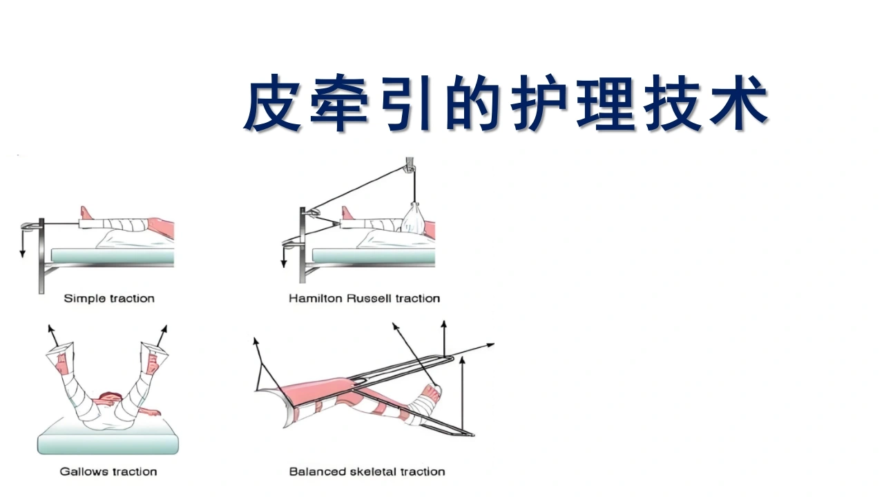 皮牵引的护理技术A278-白衣资料网