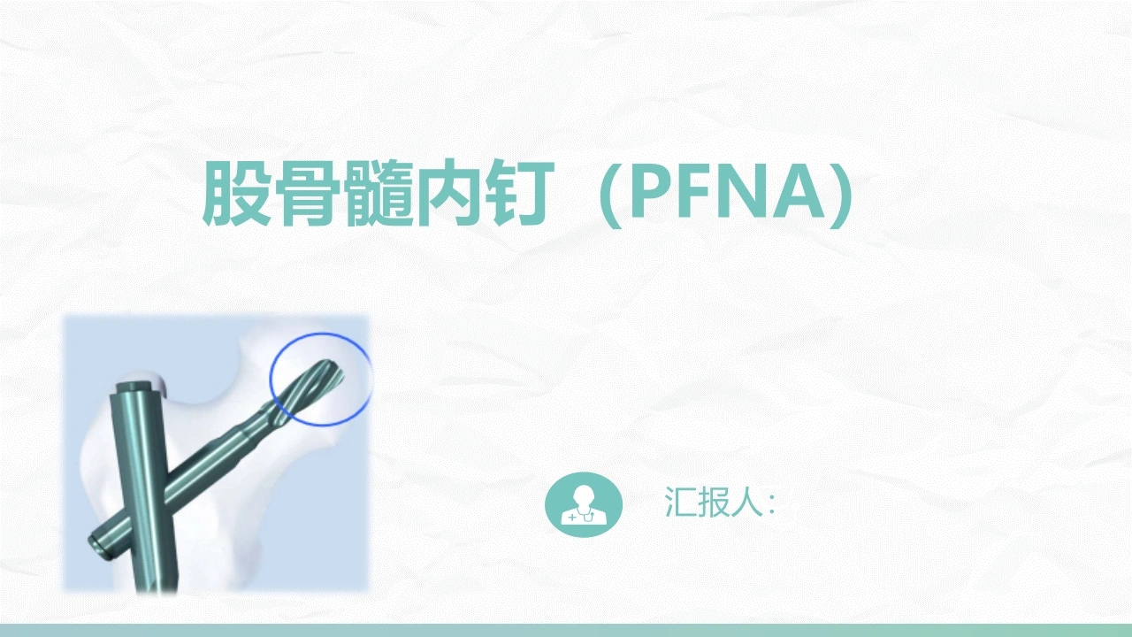 股骨髓内钉内固定术PFNAA335-白衣资料网